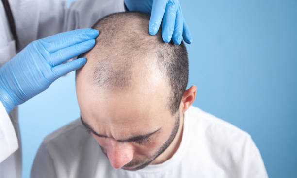 El estrés y la pérdida de cabello: ¿cómo afecta a tu salud capilar?